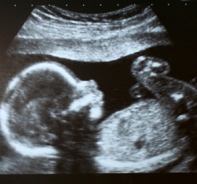 Ultraschallbild von Baby in der 22. Schwangerschaftswoche